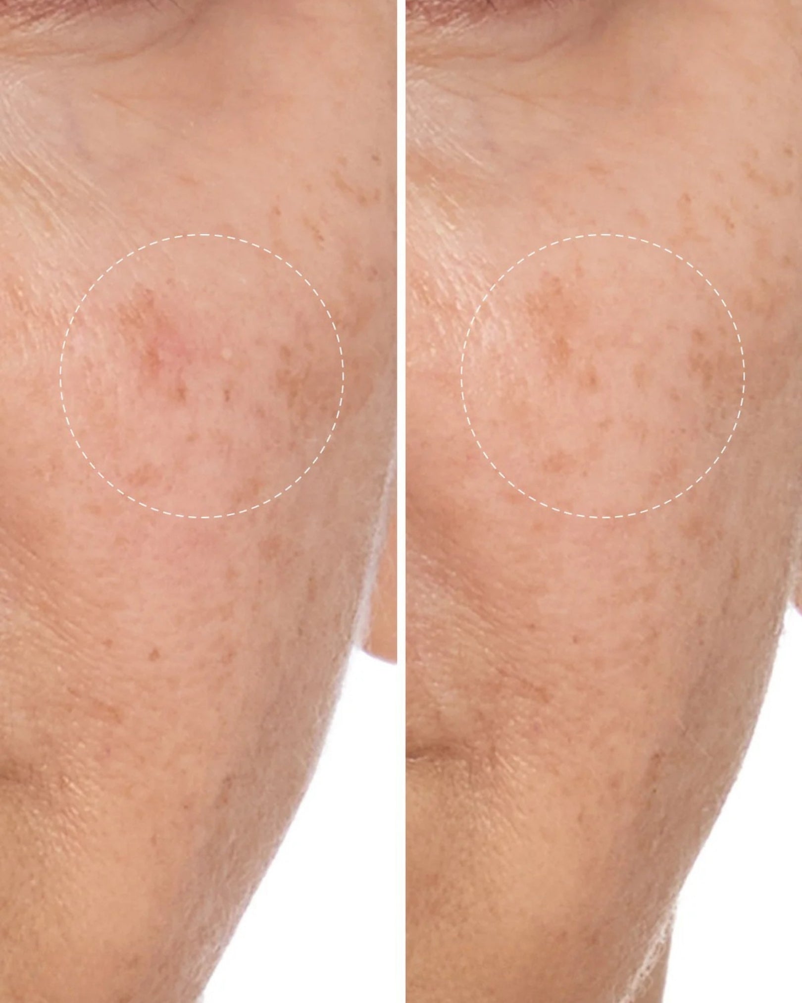 Before and after comparison of skin with a focus on a blemish.