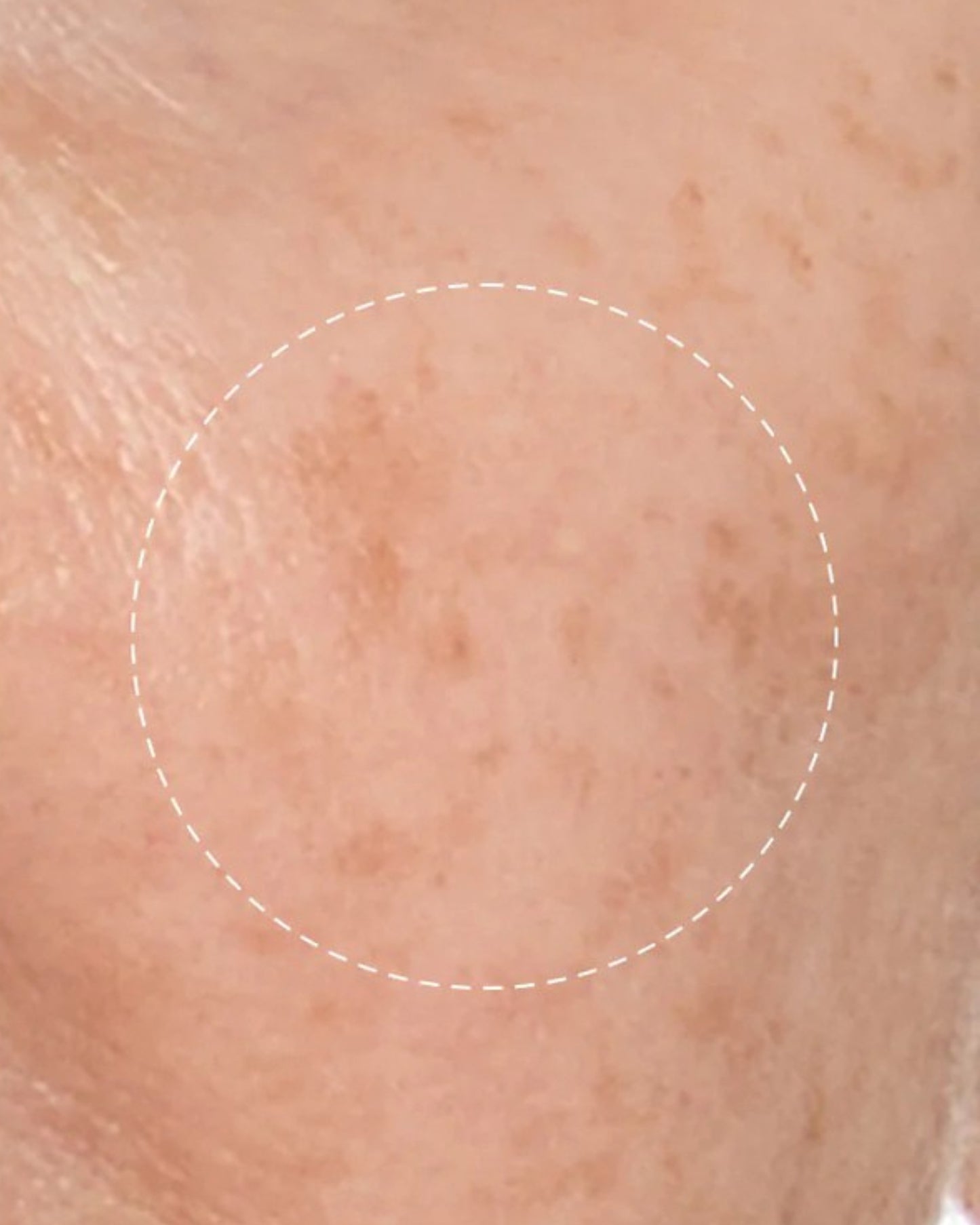 Close-up of skin with a circular mark on a beige background
