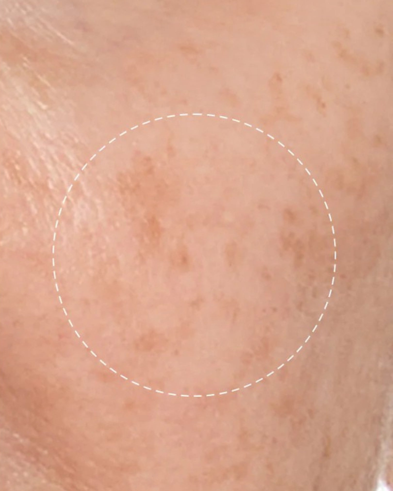 Close-up of skin with a circular mark on a beige background