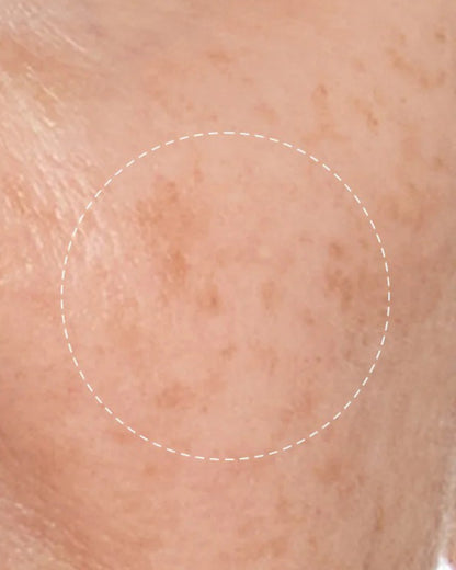 Close-up of skin with a circular mark on a beige background