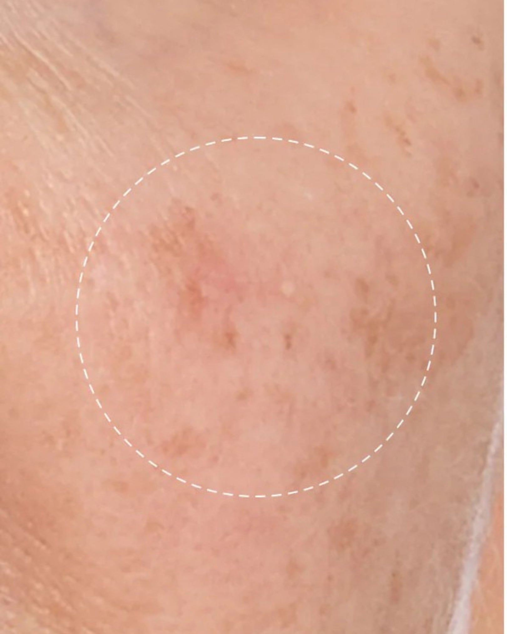 Close-up of skin with a circled area showing discoloration